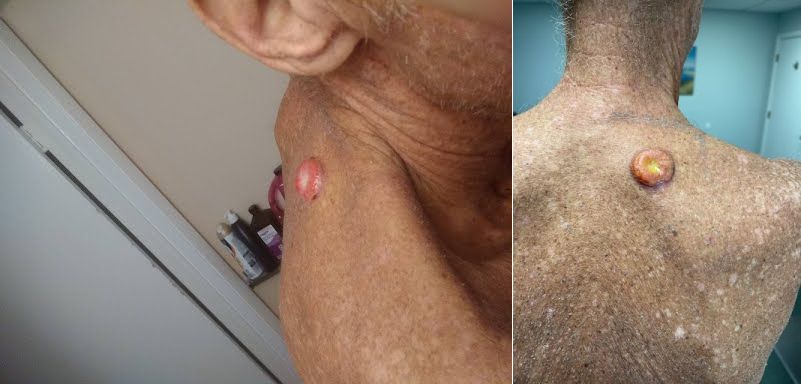2 mos. back liver wrecking all skin